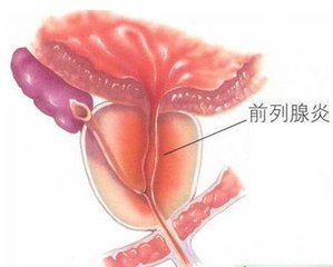 前列腺炎的治疗方式主要是哪些呢?